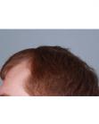 Before Hair Transplant&nbsp;Hairlines