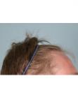 Before Hair Transplant&nbsp;Hairlines