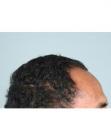 Before Hair Transplant&nbsp;Hairlines