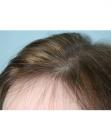 Before Hair Transplant&nbsp;Hair Thinning