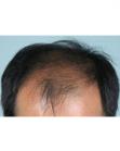 Before Hair Transplant&nbsp;2 Sessions (Areas)