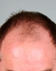 Before Hair Transplant&nbsp;Front