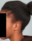 Before Hair Transplant&nbsp;Traction Alopecia
