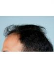Before Hair Transplant&nbsp;Hairlines
