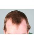 Before Hair Transplant&nbsp;Hairlines