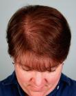 Before Hair Transplant&nbsp;Hair Thinning