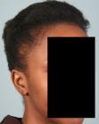 Before Hair Transplant&nbsp;Traction Alopecia
