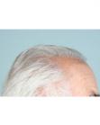 Before Hair Transplant&nbsp;Hairlines