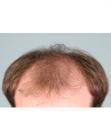 Before Hair Transplant&nbsp;Front