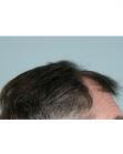 Before Hair Transplant &nbsp;Front