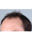 Before Hair Transplant&nbsp;Front