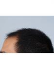 Before Hair Transplant&nbsp;Front