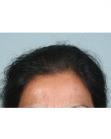 Before Hair Transplant &nbsp;Hair Thinning