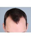 Before Hair Transplant &nbsp;Hairlines