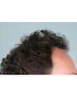Before Hair Transplant&nbsp;Temporal Hairline