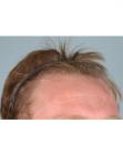 Before Hair Transplant&nbsp;Hairlines