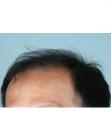 Before Hair Transplant&nbsp;2 Sessions (Areas)