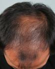 Before Hair Transplant&nbsp;2 Sessions (Areas)