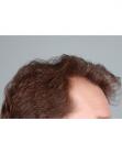Before Hair Transplant&nbsp;Hairlines