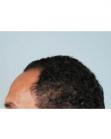 Before Hair Transplant&nbsp;Hairlines