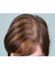 Before Hair Transplant &nbsp;Hair Thinning