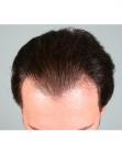 Before Hair Transplant&nbsp;Front