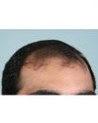 Before Hair Transplant&nbsp;Front