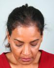 Before Hair Transplant &nbsp;Hair Thinning