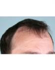 Before Hair Transplant&nbsp;Hairlines