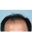 Before Hair Transplant &nbsp;2 Sessions (Areas)