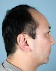 Before Hair Transplant&nbsp;Front