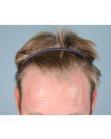 Before Hair Transplant&nbsp;Hairlines