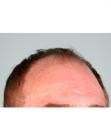 Before Hair Transplant&nbsp;Front