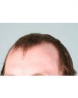 Before Hair Transplant&nbsp;Hairlines