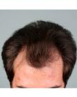 Before Hair Transplant&nbsp;Hairlines