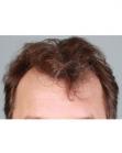 Before Hair Transplant &nbsp;Hairlines