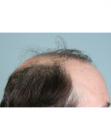 Before Hair Transplant&nbsp;Revision