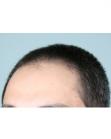 Before Hair Transplant&nbsp;Front