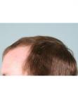 Before Hair Transplant&nbsp;Hairlines
