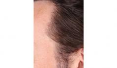Before Hair Transplant&nbsp;Temporal Hairline
