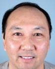 Before Hair Transplant &nbsp;Front