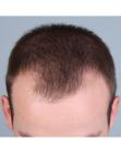 Before Hair Transplant &nbsp;Front