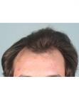 Before Hair Transplant &nbsp;Hairlines