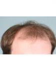 Before Hair Transplant&nbsp;Front