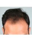 Before Hair Transplant&nbsp;Hairlines