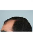 Before Hair Transplant&nbsp;Front
