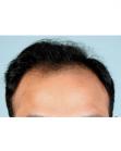 Before Hair Transplant &nbsp;Hairlines