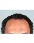 Before Hair Transplant &nbsp;Hairlines