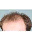 Before Hair Transplant&nbsp;Front