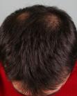 Before Hair Transplant&nbsp;Crown